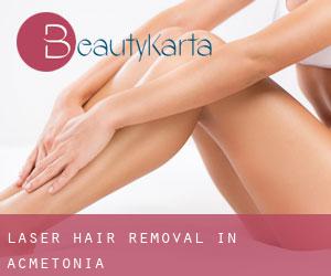 Laser Hair removal in Acmetonia