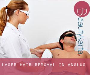 Laser Hair removal in Anglus