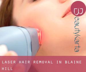 Laser Hair removal in Blaine Hill