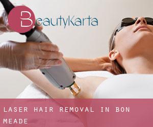 Laser Hair removal in Bon Meade