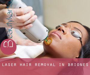 Laser Hair removal in Briones