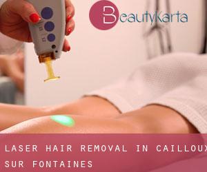 Laser Hair removal in Cailloux-sur-Fontaines